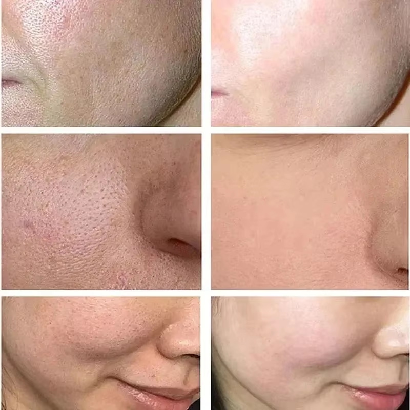 Salicylic Acid Pore Shrinking  - Skincare Salicylic Acid 评论和价格